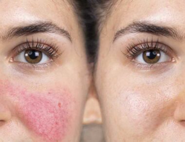 tratamiento-para-la-rosacea