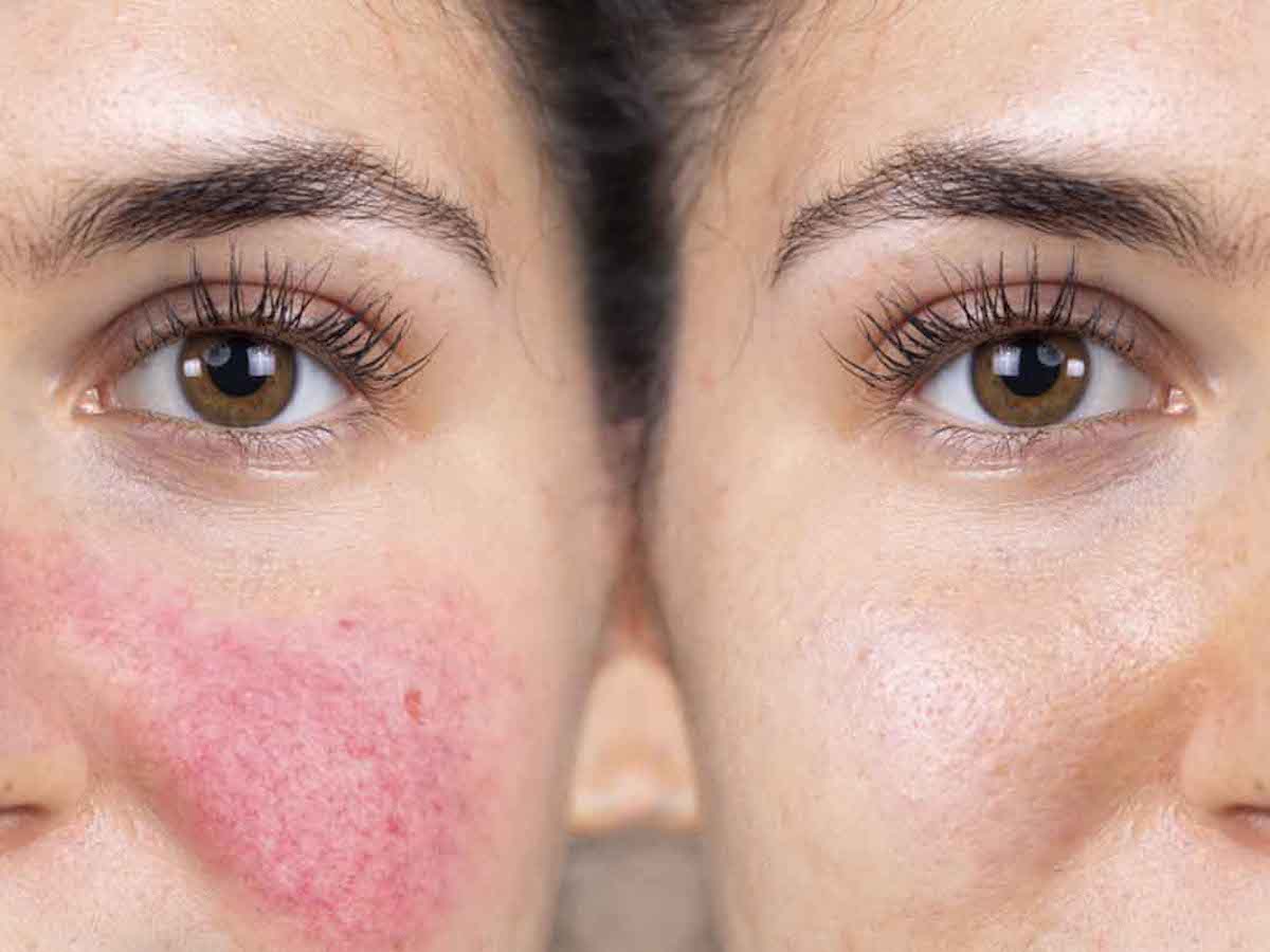 tratamiento-para-la-rosacea